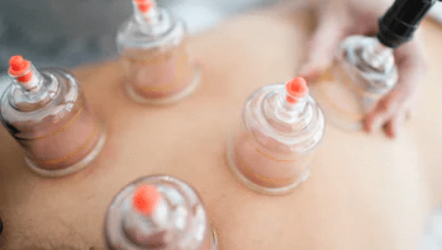 Image for Myofascial Cupping Therapy